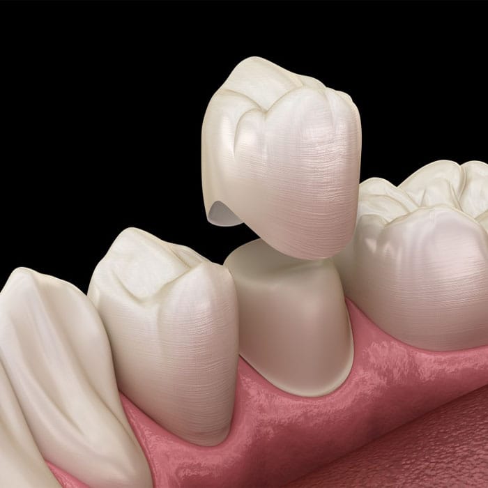 DentalCrowns