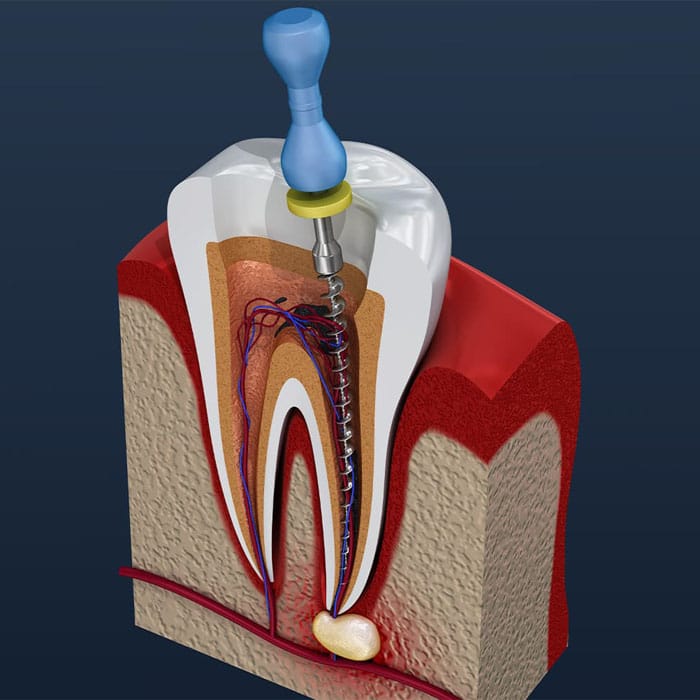 RootCanal